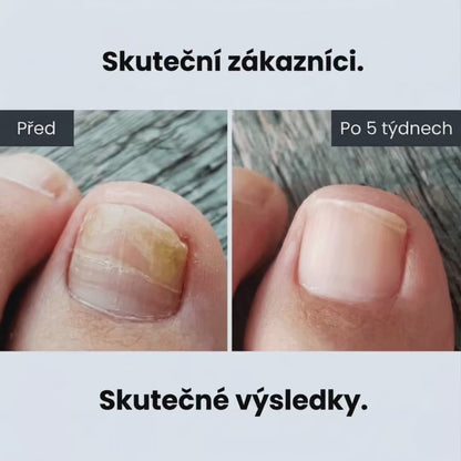 Zničte plíseň nehtů u kořene — ne jen na povrchu