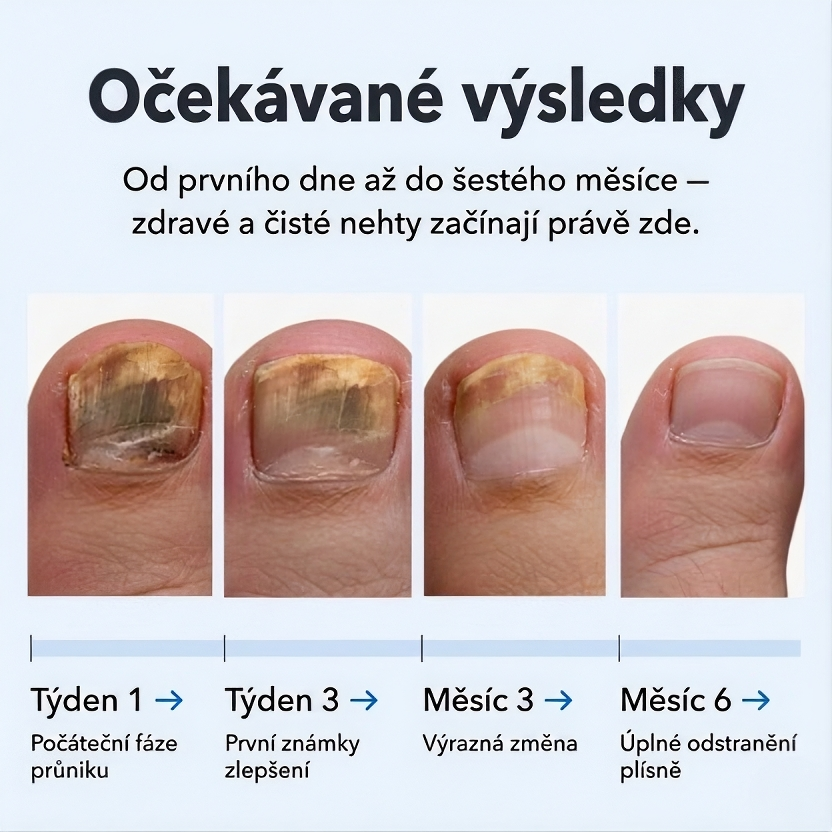 Zničte plíseň nehtů u kořene — ne jen na povrchu